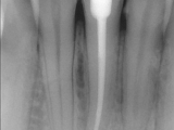Endodoncie - po